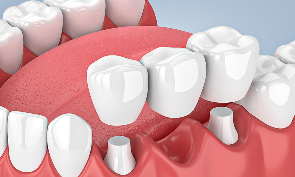 oral bridge put in by our bridge specialist in hebron ky