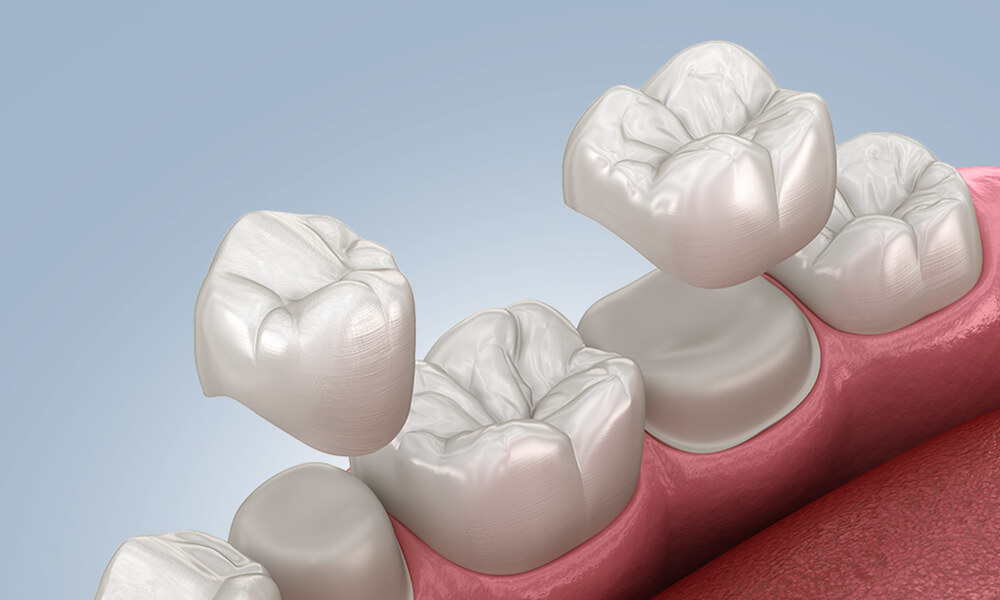 dental crown procedure performed by our Hebron dental crown dentist