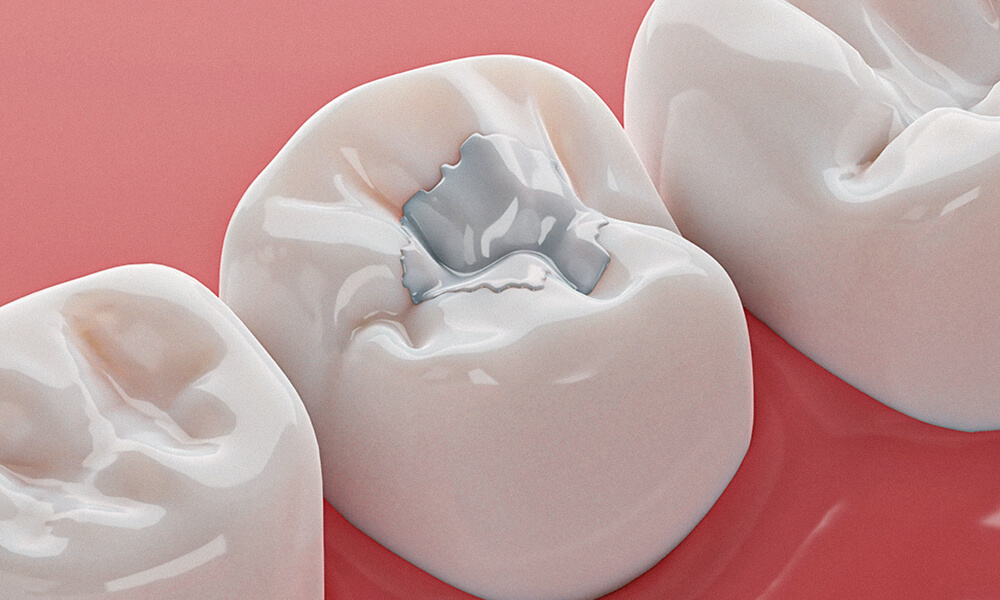 tooth filling services offered in hebron ky