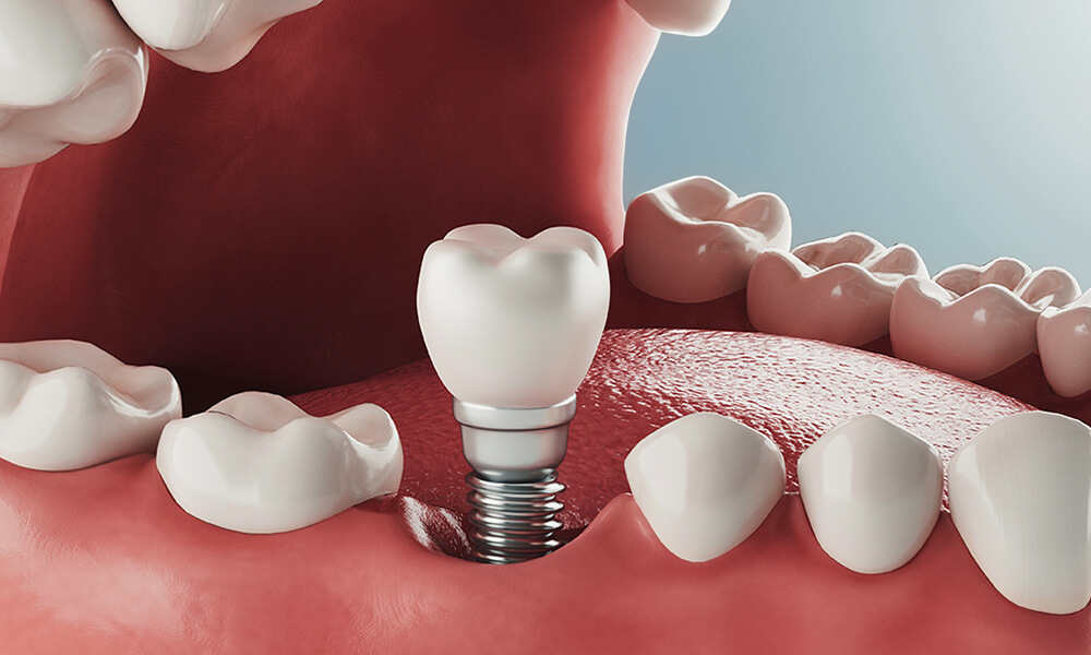 dental implants put in by our dental implant dentist in hebron ky