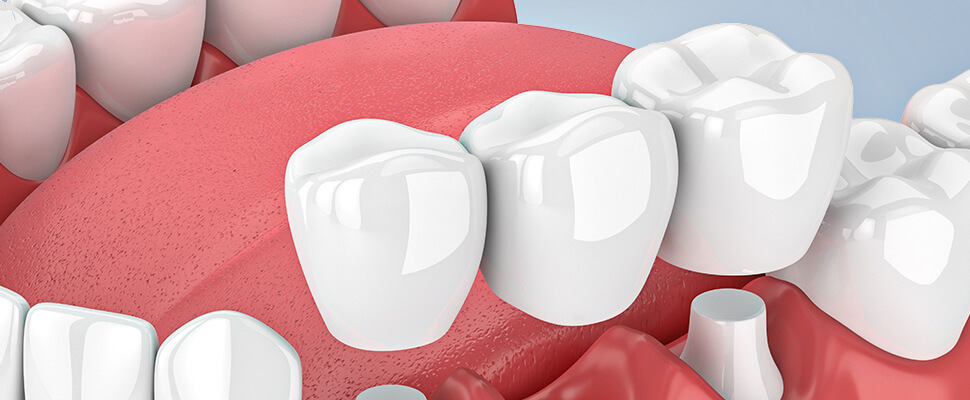 dental bridge services in hebron ky