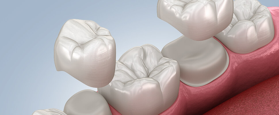 dental crowns for patients in hebron ky