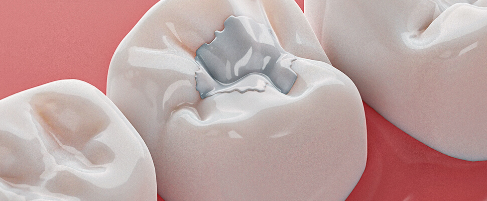 dental filling applied in hebron ky