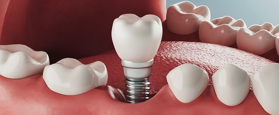 dental implant services in hebron ky